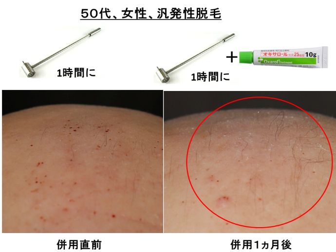 円形脱毛症　病院